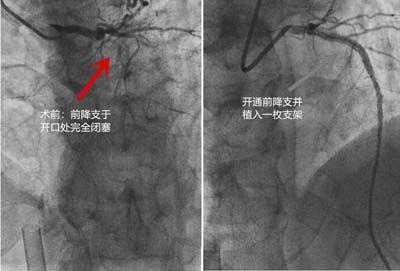 2版 冠脉介入图片.jpg